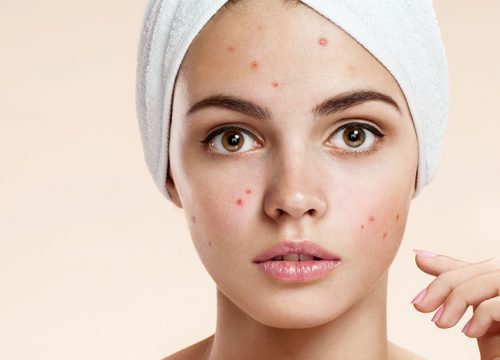 Woman with acne scars