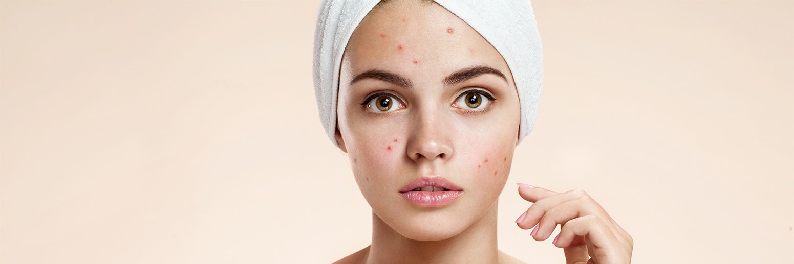 Acne and Acne Scarring