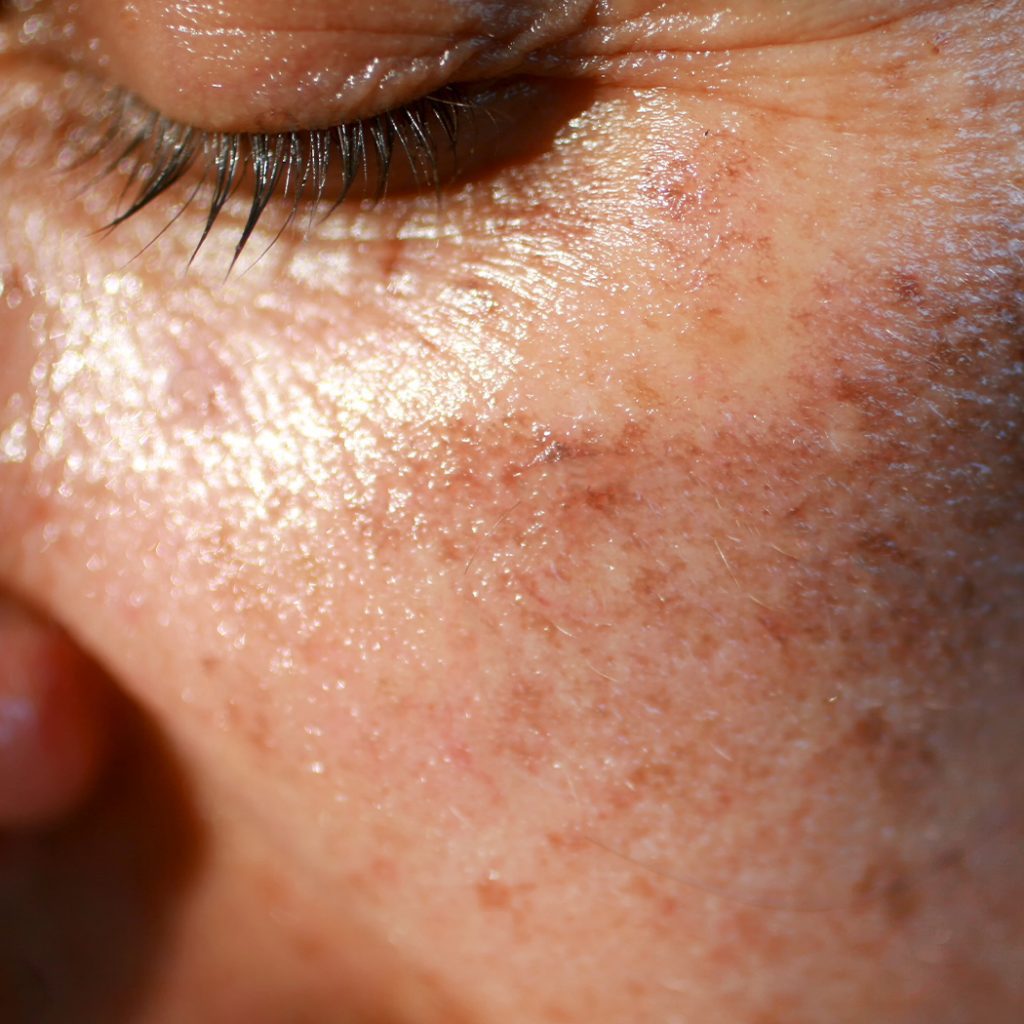 Sun spots on face