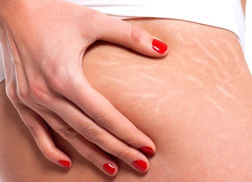 Stretch marks on a woman's body