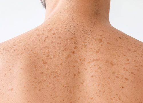 Sun spots and freckles on a man's back