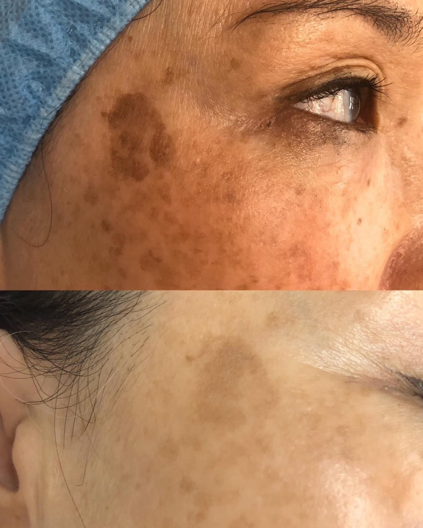 Best Microdermabrasion Facial NYC, Manhattan Le Parlour Laser