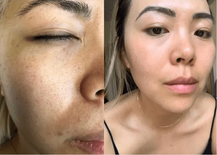 Before and after laser facial results