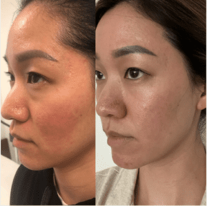 Before and after laser facial results