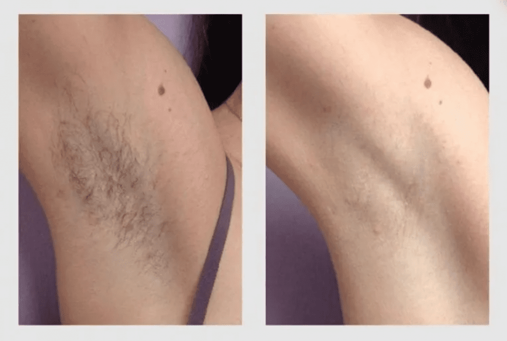 Before and after laser hair removal results