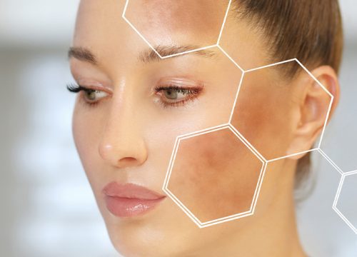 Woman with hyperpigmentation on her face