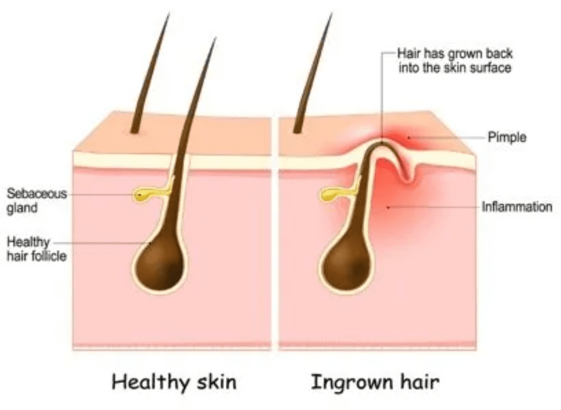 Healthy skin vs. ingrown hair comparison