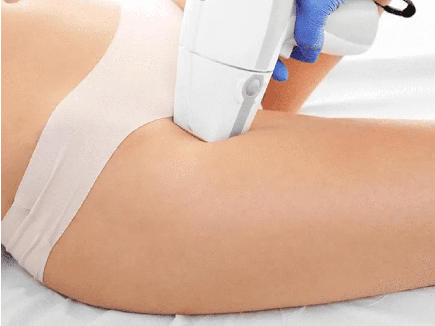 laser hair removal