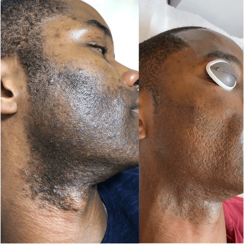 Man's before and after laser hair removal results