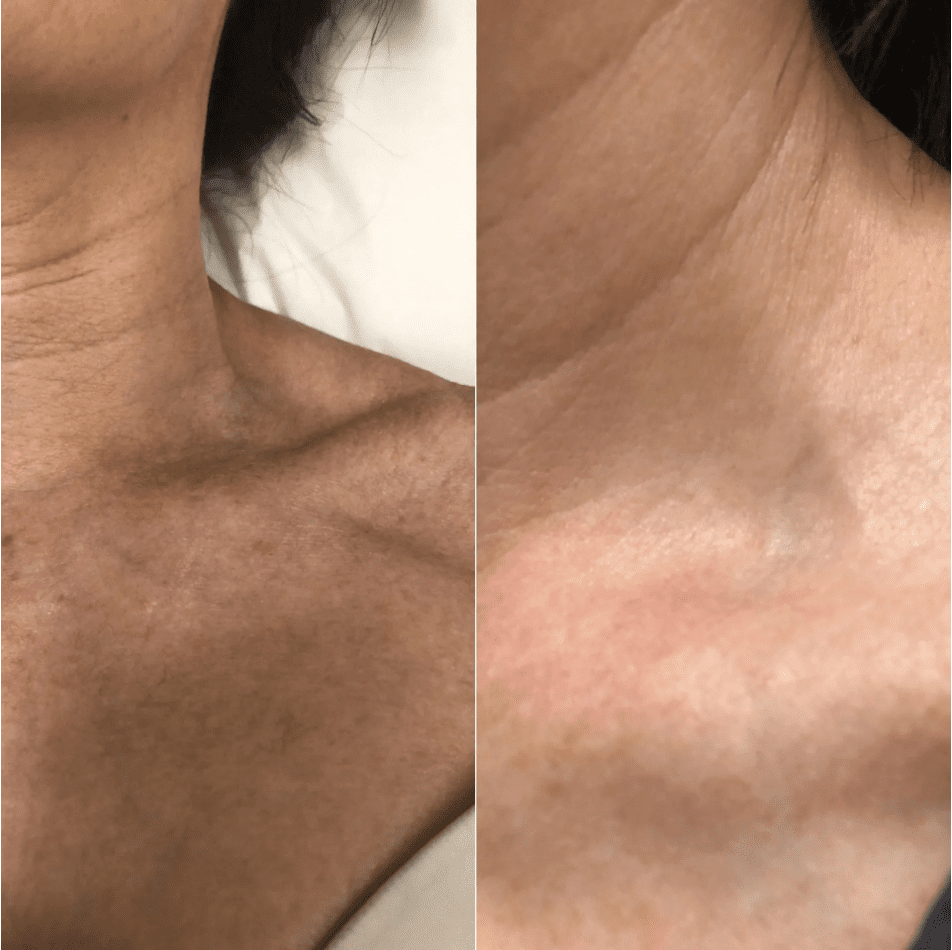 Before and after spider vein removal results