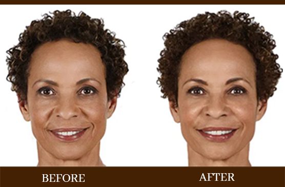 Before and After facial fillers