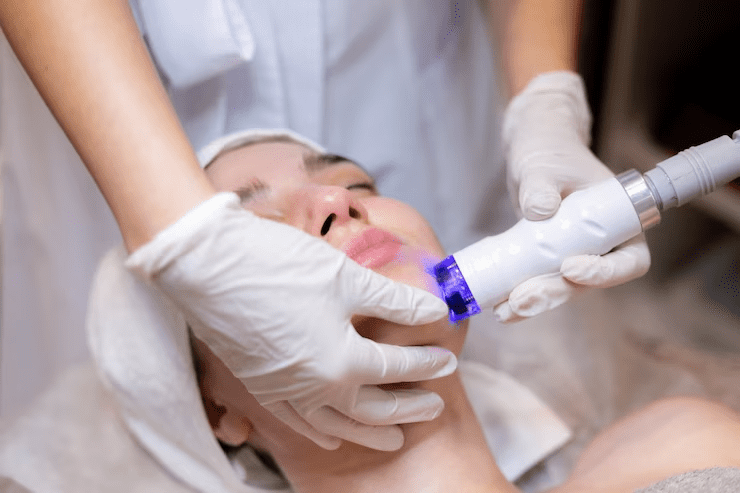 woman getting chin Laser Hair Removal