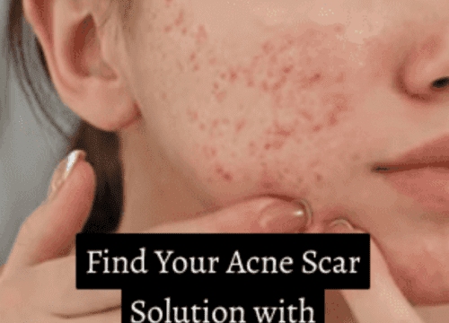 woman with bad acne